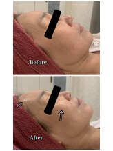 ブランシュール/エンビロンペプチド導入