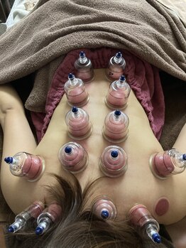 はりめぐり/カッピング吸い玉