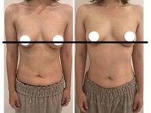 デミーナ(Demyna)/【バストアップ・育乳】症例