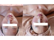 ムーンブロッサム(MoonBlossom)/しわ、毛穴改善ヒト幹細胞エステ