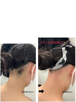 メディカルサロンドオフ 堺東店(medical salon de off)/うなじ＆襟足脱毛