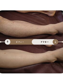 ジュゴン(Dugong)/足の全体脱毛（Before＆After）