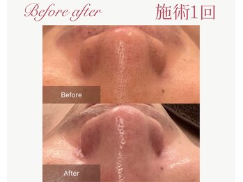 パルタージュ 三宮(Partage)/一回で毛穴レスが叶う♪