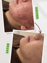 ダブリュービー(WB)/ハードハーブピーリング5回目