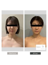 シーボウ(CBOU)/脂肪よう解　5ml(小顔)