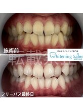ホワイトニングサロン 福岡天神店/ホワイトニング