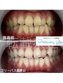 ホワイトニングサロン 福岡天神店/ホワイトニング