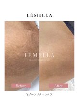 エルビービュティーサロン(LB BEAUTY SALON)/【ルメラ乳輪】実績数関西1★