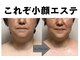 小顔専門サロン ラリューシュ(La ruche)の写真/憧れのキュッと引き締まった立体的な小顔を実現！目元もパッチリ＆鼻筋もシュッ◎埋もれた輪郭もスッキリ♪