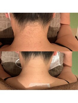 ビューティーデザインアウル(BEAUTY DESIGN OWL)/うなじBefore→after