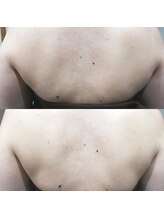 RiとBiのたまご/（ブライダル）5回before-after