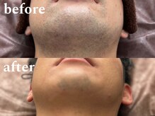 ボス 津店(BOSS)/【メンズ脱毛/ヒゲ脱毛】