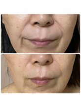 アンヘル(Angel)/リアボーテグランハーブ1回