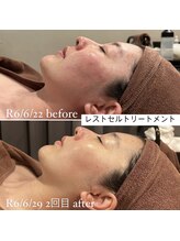 ミエル 神戸店(Miel)/リアボーテレストトリートメント