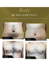 リラ(Lilas)/美肌ケアしながらボディ脱毛