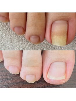 歩くと痛い巻き爪!60分で緩和