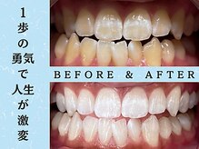 ホワイトニングショップ 八王子店/ホワイトニングビフォーアフター