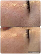 サロンドラニ(salon de LANI)/【プラズマフェイシャル】症例