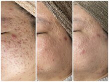 アロマ(AROMA)の雰囲気（ニキビケア、毛穴専門◎越谷/せんげん台/大宮/春日部/草加/）