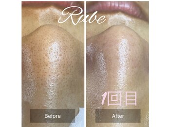 ルーエ(Ruhe)/毛穴エクストラクション