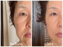 ルー ハナレ 神戸岡本 摂津本山店(Luu HANARE)/3回 小顔リフトアップ　しわ改善