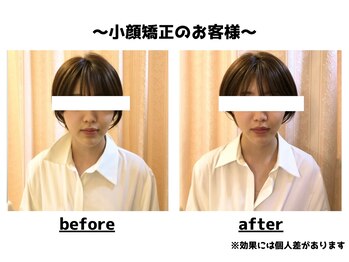 トータルビューティーみつとも/小顔矯正/インディバ/EMS