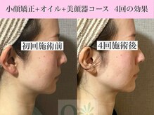 キュープ 表参道店(Qpu)/美顔器モニターコース4回の変化