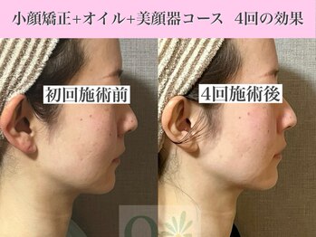 キュープ 表参道店(Qpu)/美顔器モニターコース4回の変化