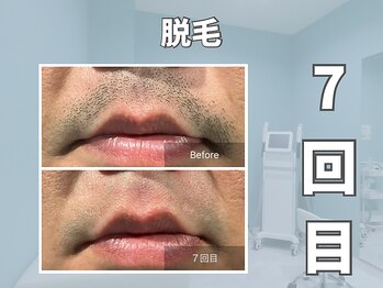 エックス(X)/【メンズ脱毛】髭脱毛