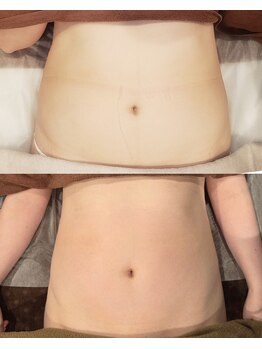 トータルエステティック ジョワイユ(JOYEUX)/3ヵ月集中お腹ケア