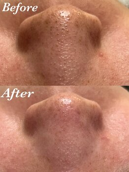 コリー(Kolly)/美容液で洗う毛穴洗浄