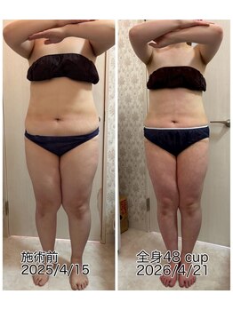 クールスパ(COOL SPA)/40代女性 お腹症例