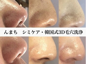 んまちの写真/<韓国式3D毛穴洗浄>自己流の毛穴ケアしていませんか??押し出さず浮かせる施術で毛穴がすっきり引き締まる★