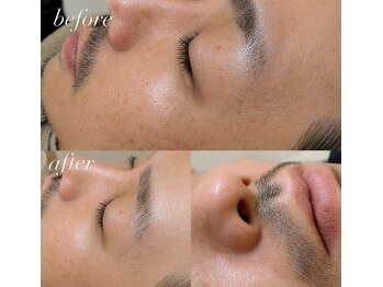サロンエヌ(salon N)/メンズのセラピール＋鼻毛WAX