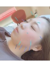 ハピネス(Happiness)/美容鍼イメージ1