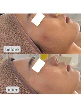 ルシェリア(Le cherien)/陶肌トリートメント