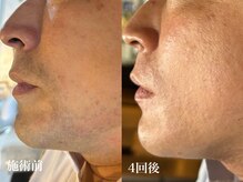 ニコ(Nico)/ヒゲ脱毛