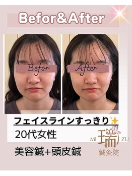 瑞 鍼灸院/頭皮鍼+美容鍼　20代