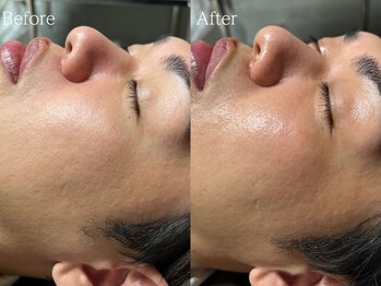 ルミナ シブヤ(LUMINA SHIBUYA)/【ダクトピール】1回目　横顔