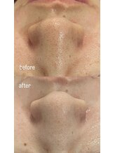 シャレール アリオ鷲宮店(Chareir)/小鼻毛穴洗浄/before→after