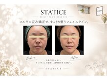 スターティス 麻布十番店(STATICE)の雰囲気（エラ張り/毛穴/シワ/たるみ/くすみ/左右差/ニキビ/二重あご）