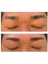 レヴィオ(REVIO)/ハリウッドブロウリフト