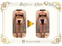 カワイ ビューティーサロン 新宿西口店(Kawai Beauty Salon)/【ハイパーナイフ】before/after