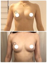 デミーナ(Demyna)/【バストアップ・育乳】症例