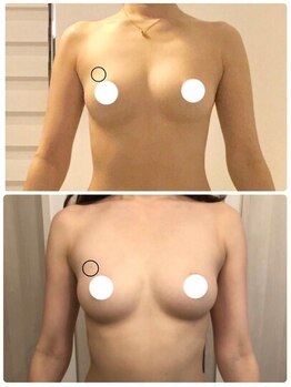 デミーナ(Demyna)/【バストアップ・育乳】症例