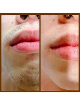 リアンジュ/ヒゲ脱毛の経過