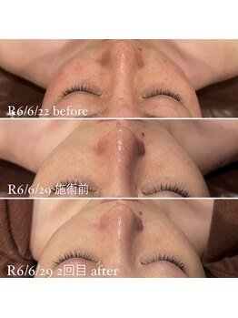 ミエル 神戸店(Miel)/リアボーテレストトリートメント