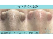 リメイククリニカルビューティー(Remake clinical beauty)/毛穴の深さが気になる方は