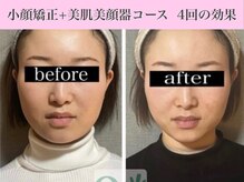 キュープ 表参道店(Qpu)/美顔器モニターコース4回の変化