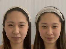 エスツリービューティーアンドネイル(S-TREE BEAUTY&NAIL)/【小顔】ビフォーアフター